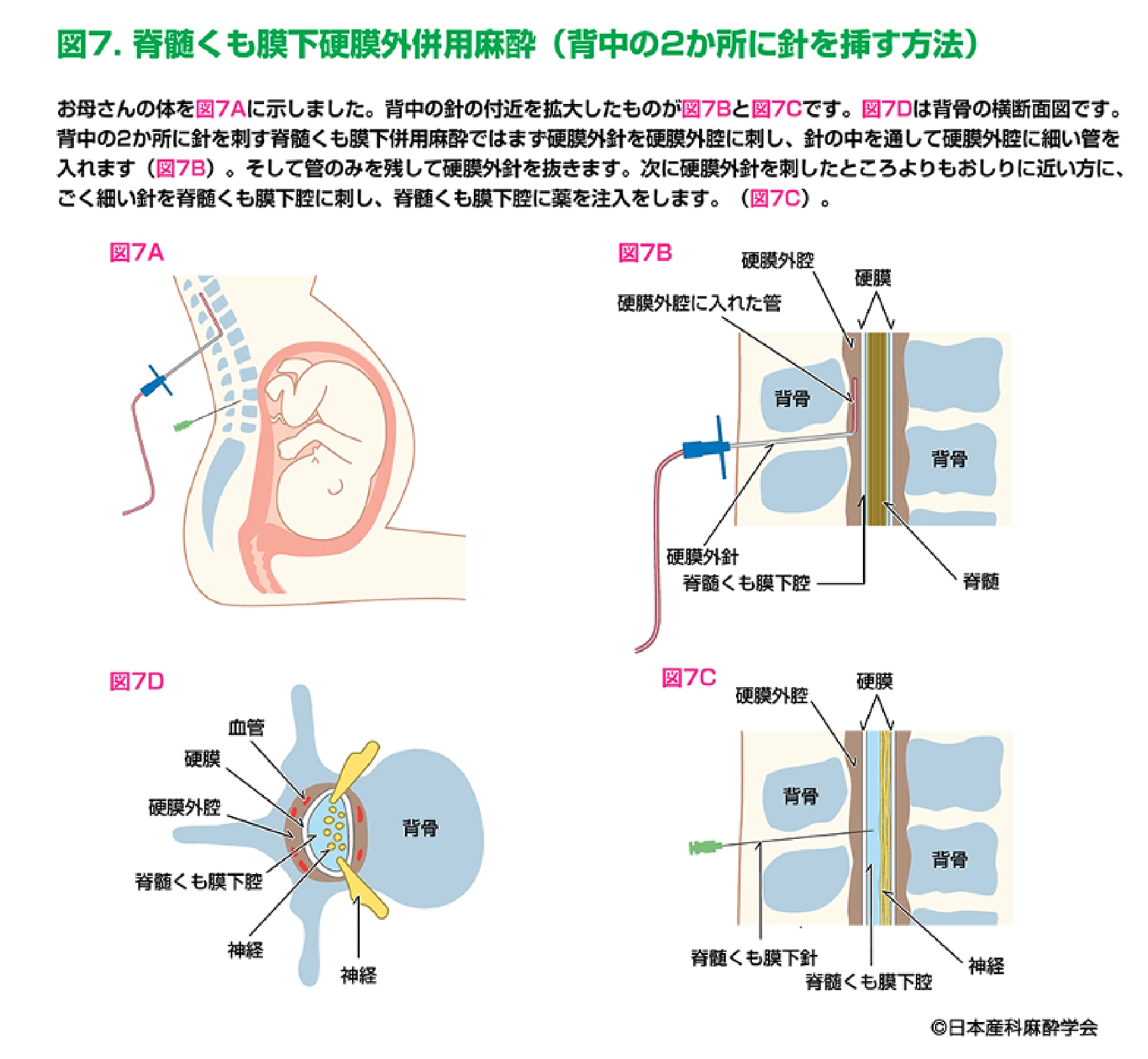脊髄くも膜下硬膜外併用麻酔（背中の2か所に針を挿す方法）